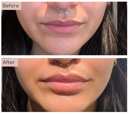 lip fillers before and afters